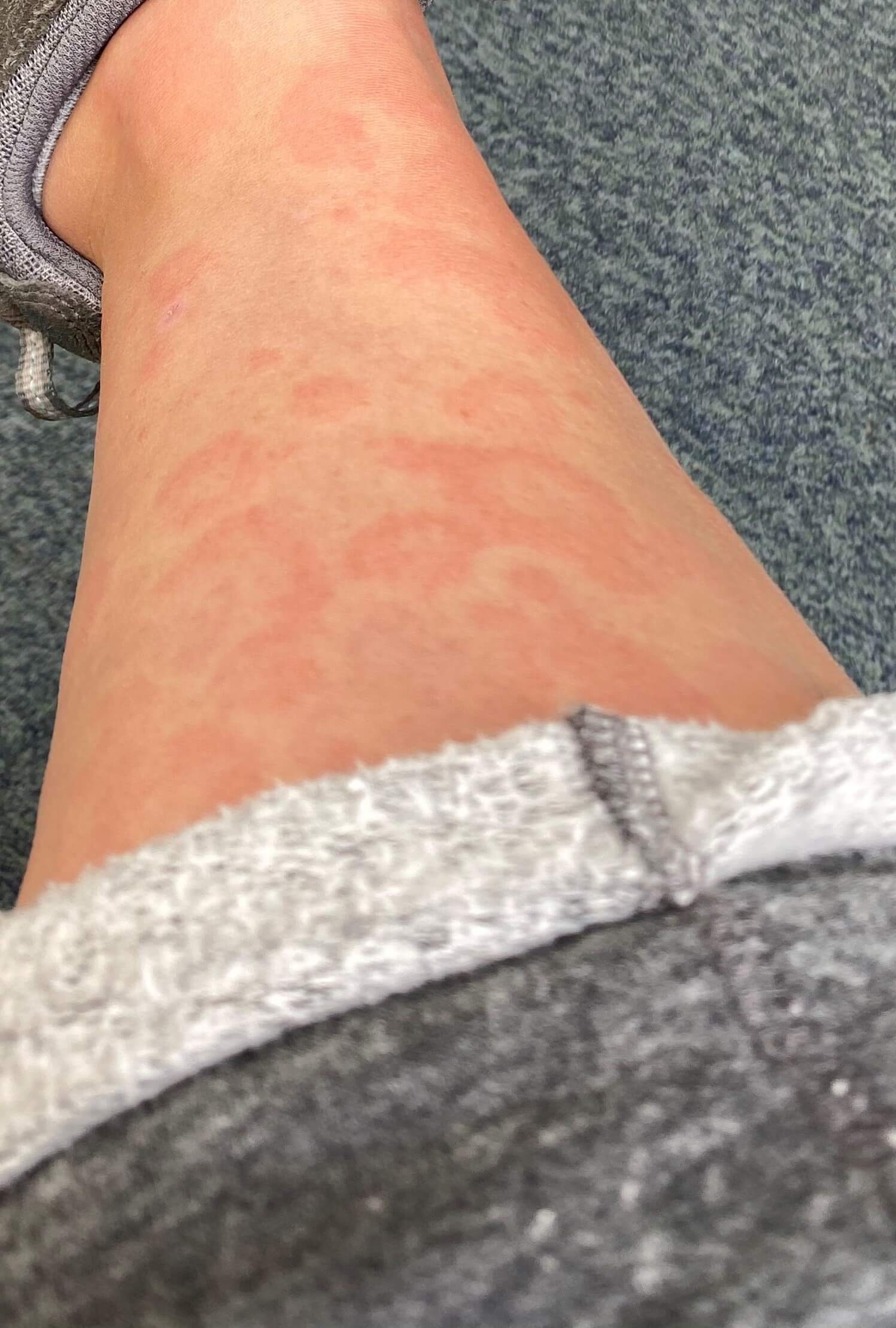 There are several common causes for an itchy scalp, such as various forms of dermatitis, or reactions to certain hair products. Skin rash should be considered as a fourth key sign of